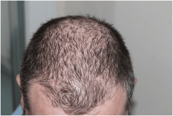 hair loss