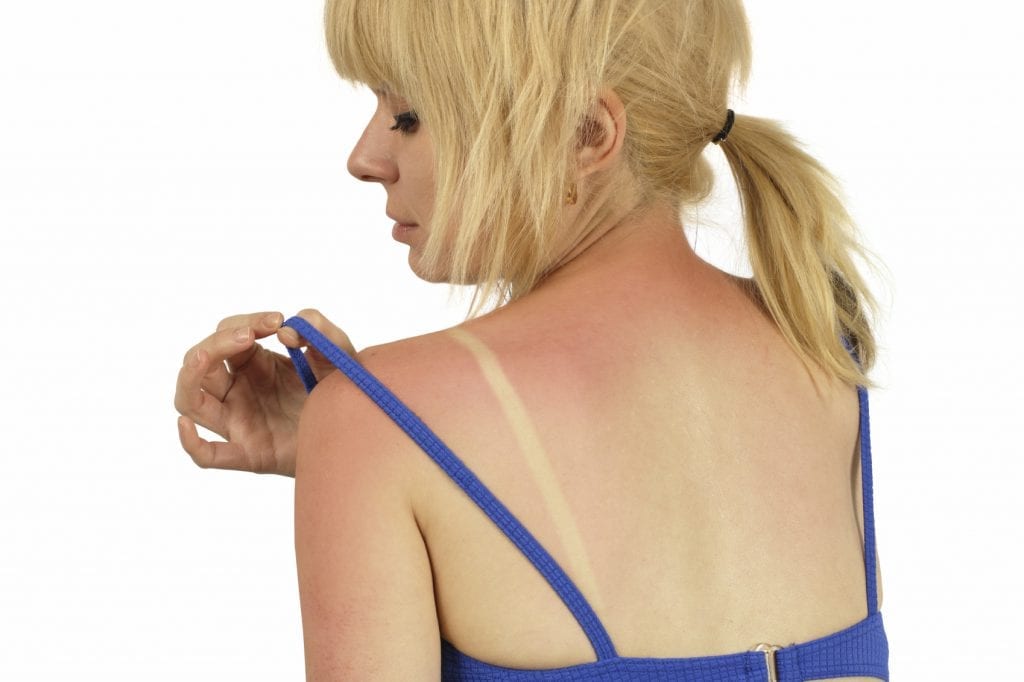 Sun Burn - iStock_000007429119_Medium