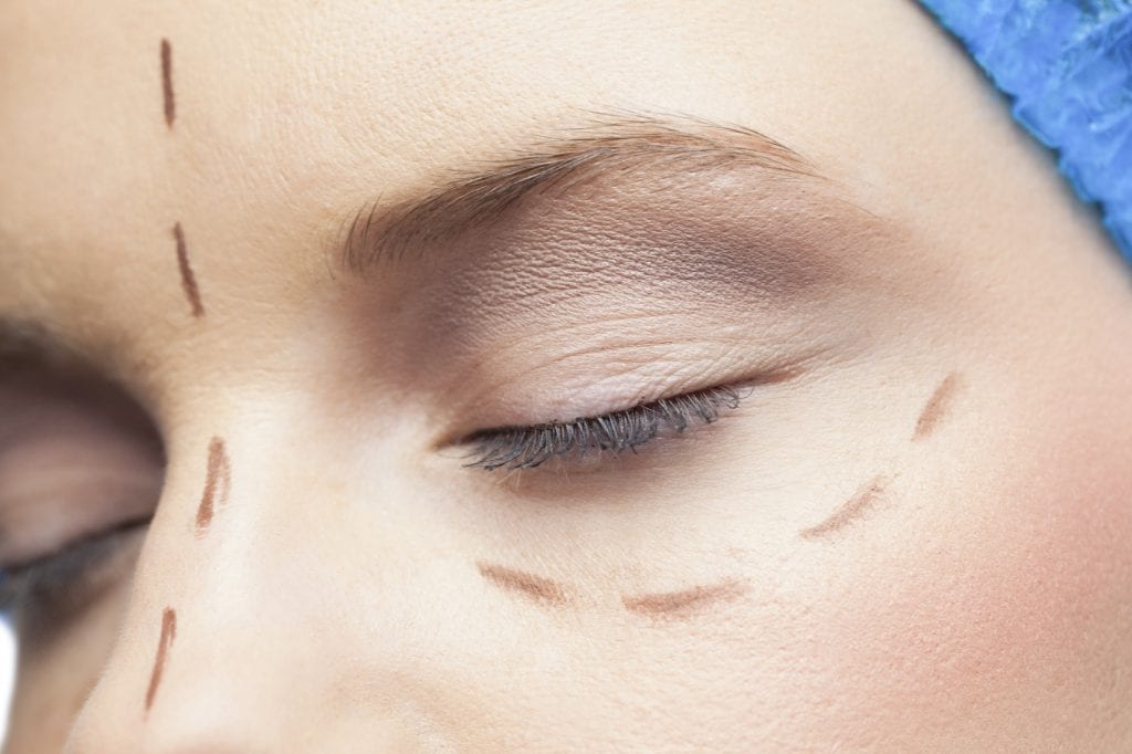 Extreme close up on relaxed patient with dotted lines on the face before surgery