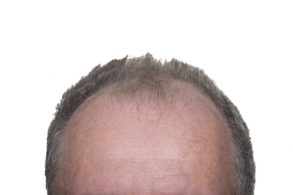 Male Pattern Baldness - iStock_000015895375_Medium