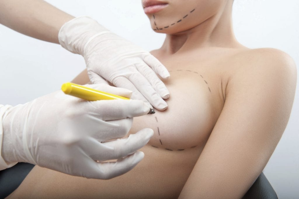 Plastic surgery doctor draw line on patient breast augmentation