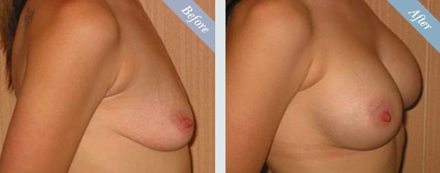 Breast Augmentation Before & After 2