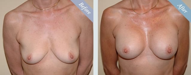 Breast Augmentation Before & After 3
