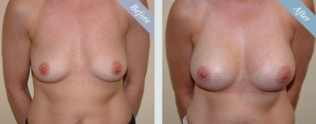 Breast Augmentation Before & After 3