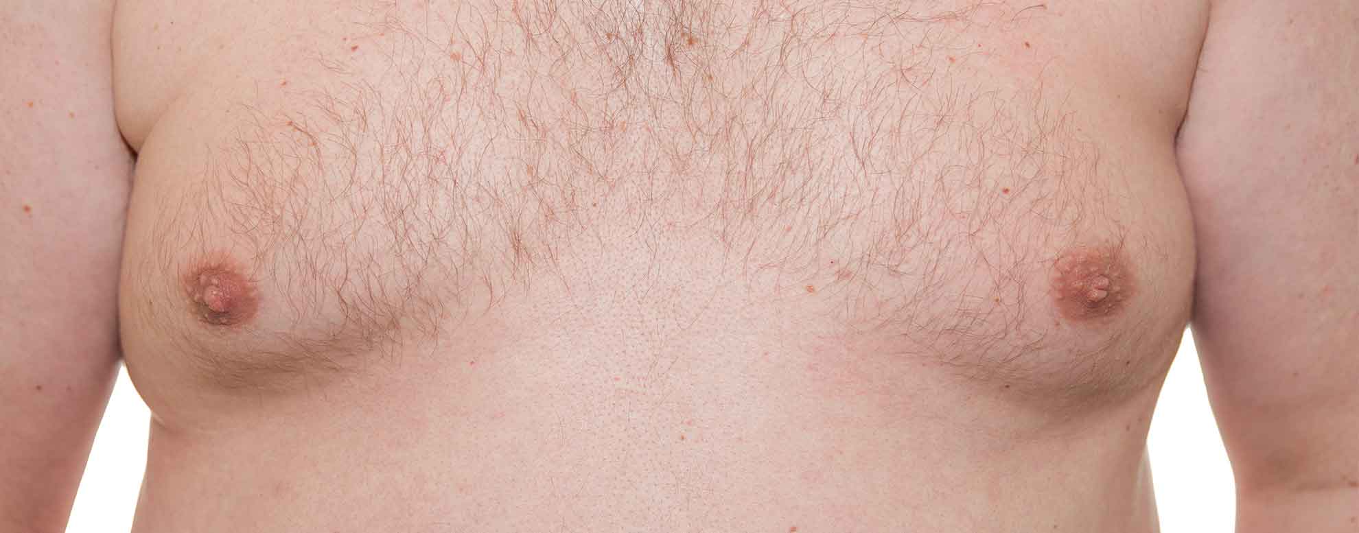 close up of a man's chest with gynecomastia