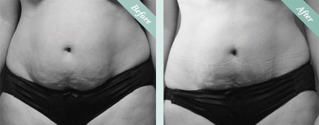 Fat Freezing (Cristal Cryolipolysis) Before & After 1