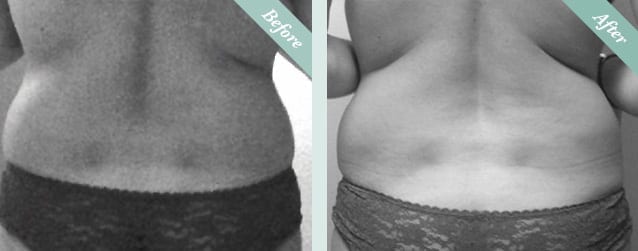 Fat Freezing (Cristal Cryolipolysis) Before & After 2