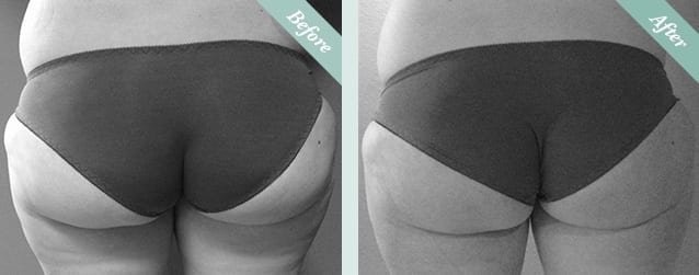 Fat Freezing (Cristal Cryolipolysis) Before & After 3