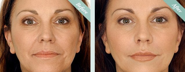 Before and after dermal fillers