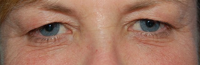 Eyelid Surgery (Blepharoplasty) Before