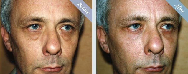 Eyelid Surgery (Blepharoplasty) Before & After 2