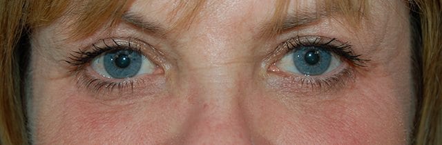 Eyelid Surgery (Blepharoplasty) After