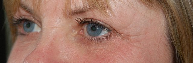 Eyelid Surgery (Blepharoplasty) After