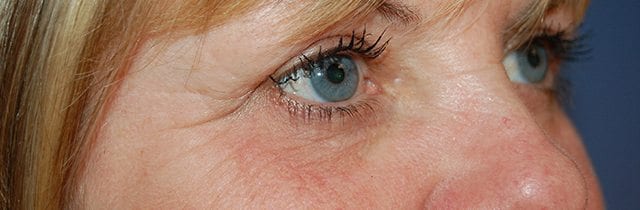 Eyelid Surgery (Blepharoplasty) After
