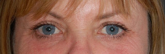 Eyelid Surgery (Blepharoplasty) After