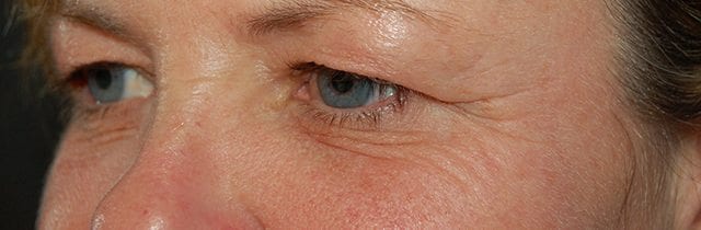 Eyelid Surgery (Blepharoplasty) Before