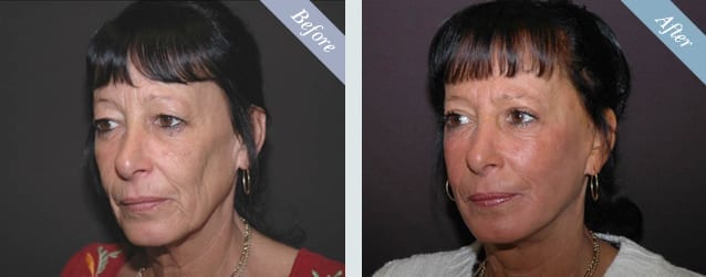 Facelift Before & After 1