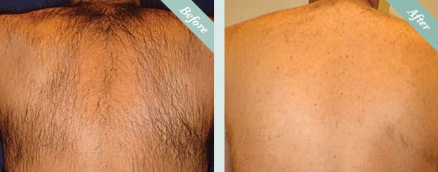 Laser Hair Removal Before & After 3