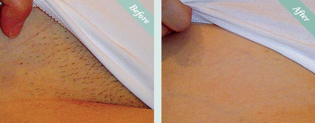 Laser Hair Removal Before & After 4