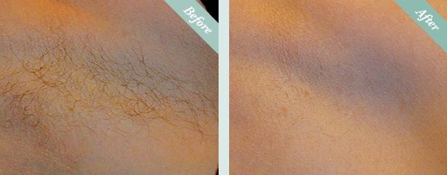 Laser Hair Removal Before & After 1