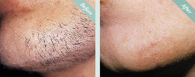 Laser Hair Removal Before & After 2