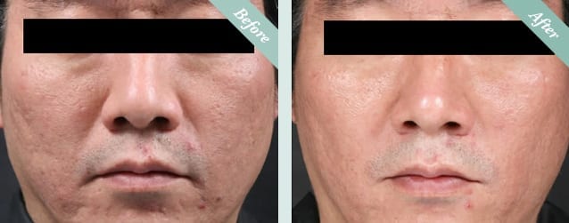 INTRAcel Radiofrequency Microneedling Before & After 1