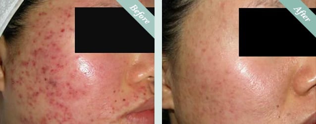 INTRAcel Radiofrequency Microneedling Before & After 3