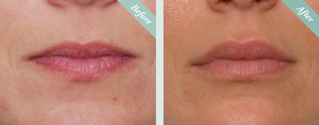 Lip Fillers Before & After 1