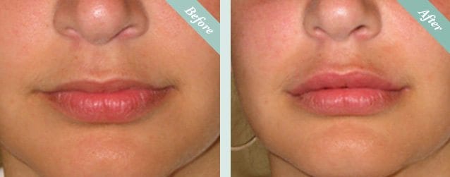 Lip Fillers Before & After 2