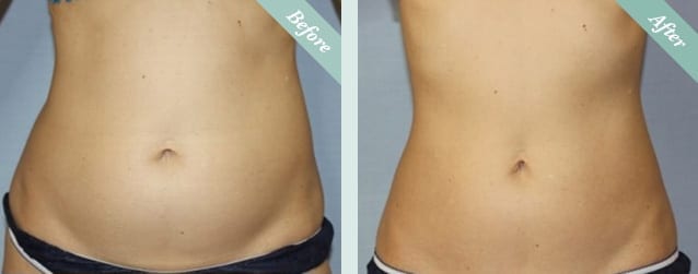 Lipocel Body Contouring HIFU System Before & After 1