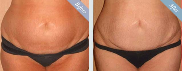 Tummy Tuck Surgery Before & After 1