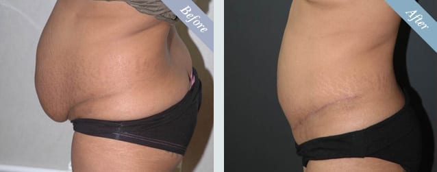 Tummy Tuck Surgery Before & After 2