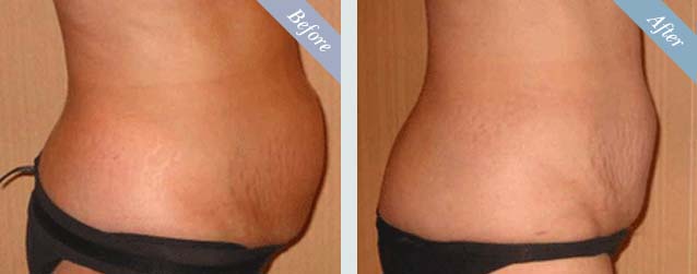 Tummy Tuck Surgery Before & After 3