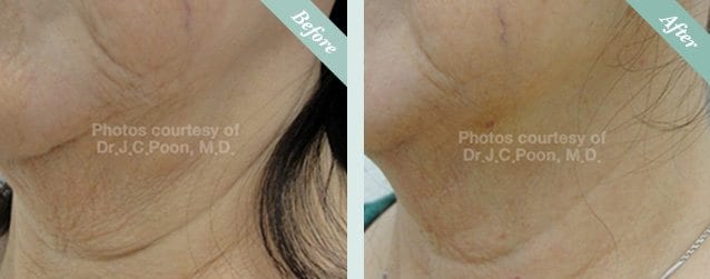 Ultracel HIFU Before & After 1