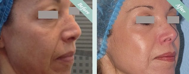 Ultracel HIFU Before & After 4