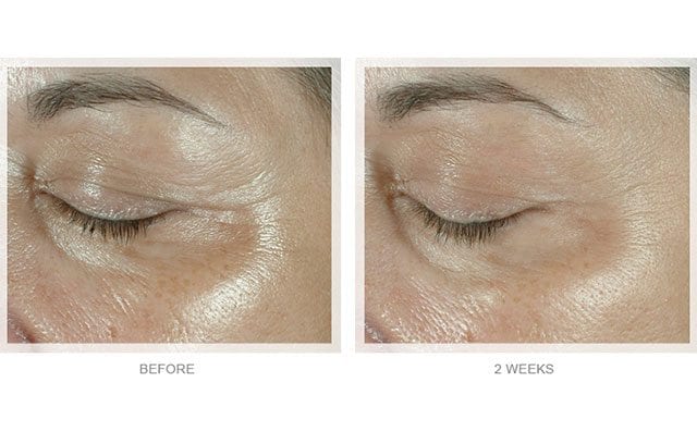 Obagi Before & After 4
