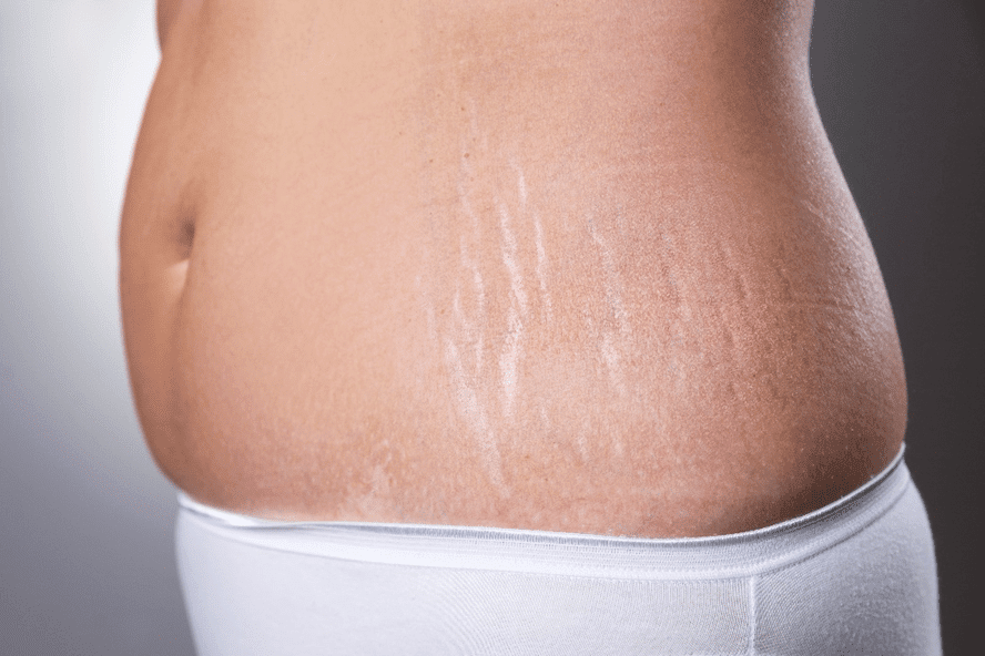 Stretch marks on the side of the stomach