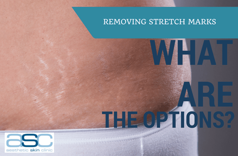 Stretch marks custom image