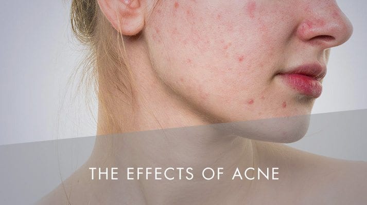 The Effects of Acne