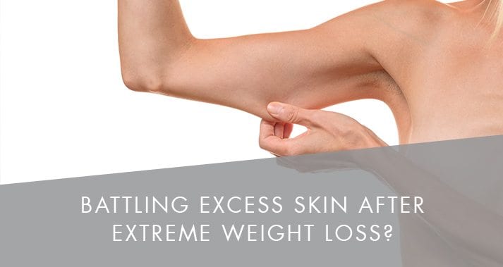 Battling Excess Skin After Extreme Weight Loss