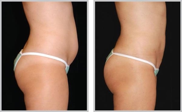 Non-Surgical Fat Removal