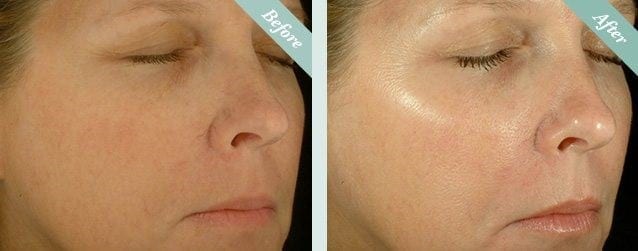 Non-Surgical Skin Peels 