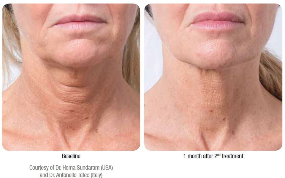 Profhilo before and after treatment