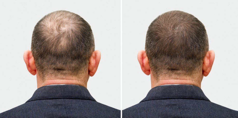 Before after hair transplant