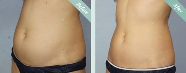 Before and after body contouring