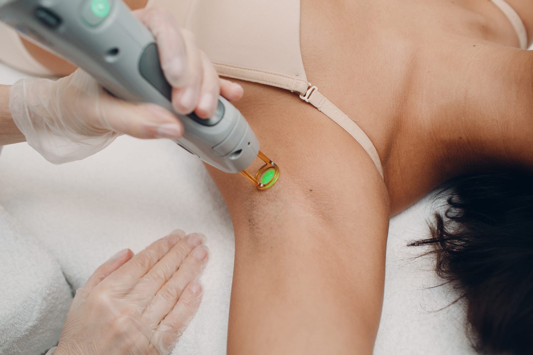 Laser hair removal in armpit