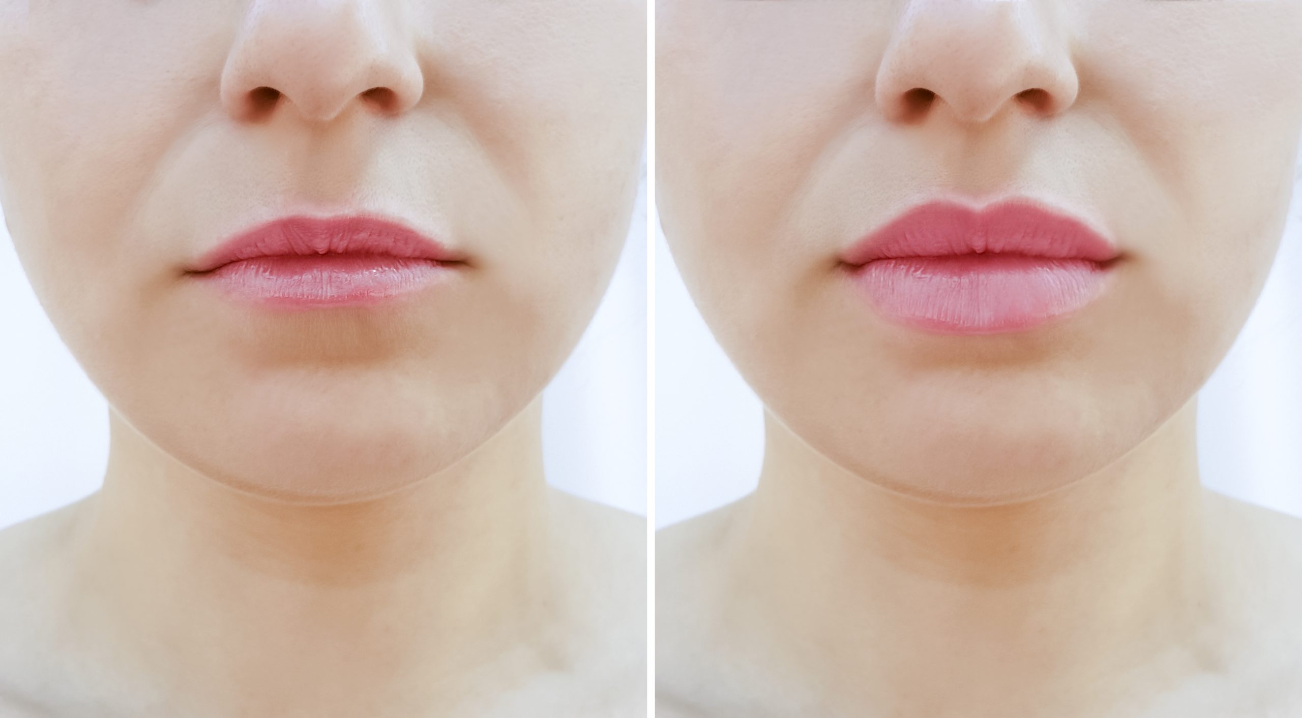 Woman's lips before and after fillers