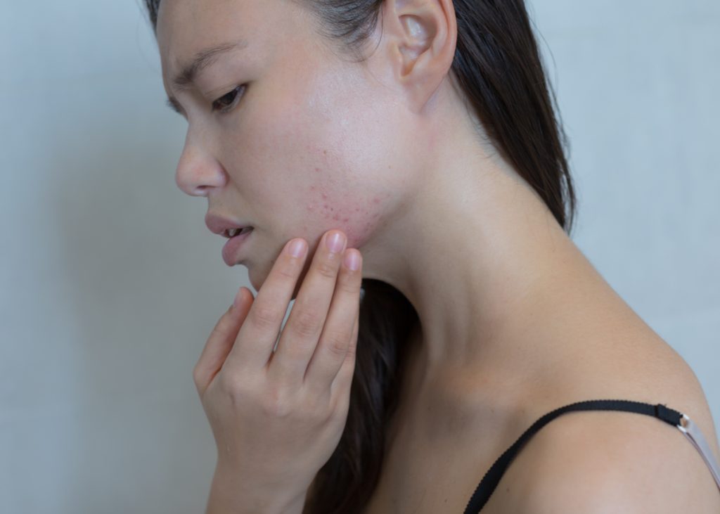 Woman suffering from stress induced acne