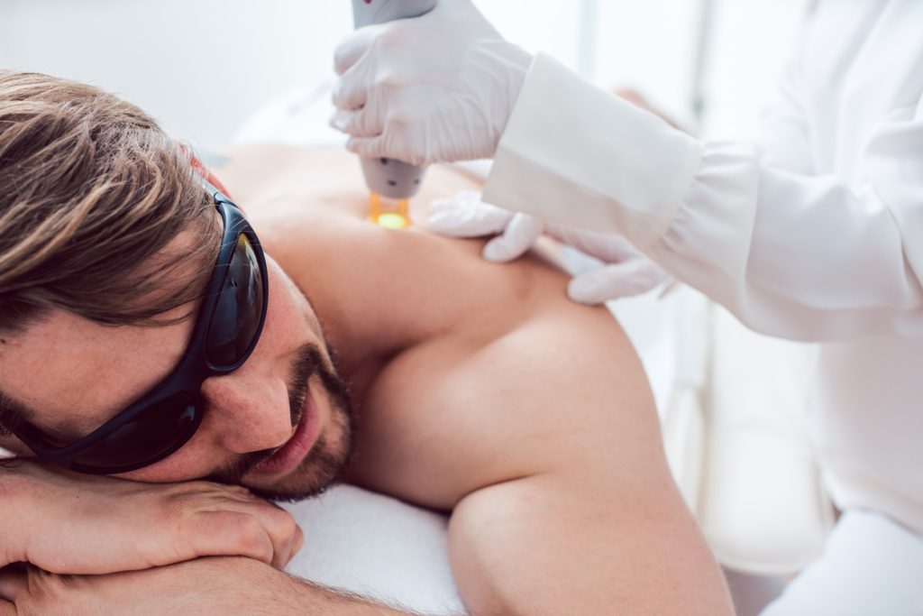 Laser hair removal on the back