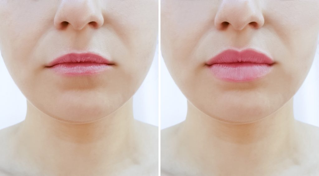 Lip fillers before and after image
